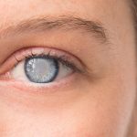 Cataracts